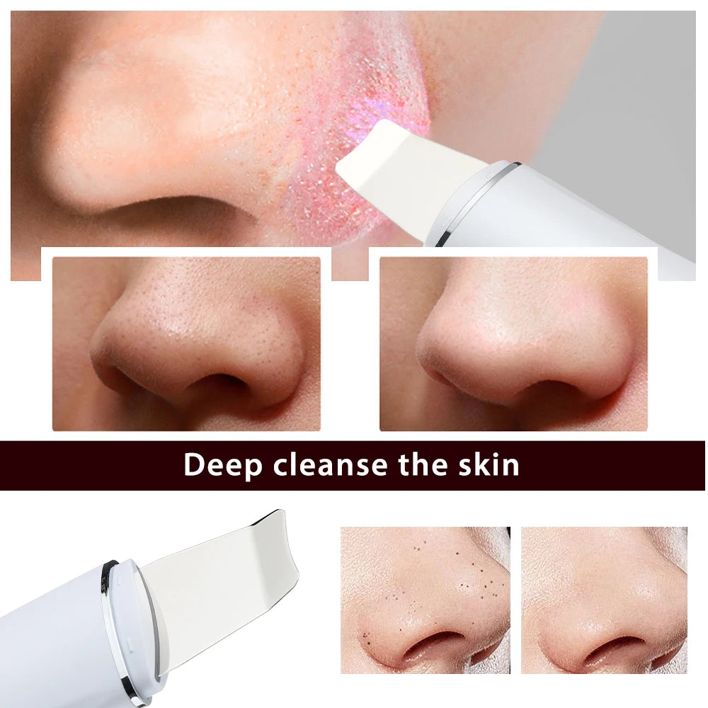 Ultrasonic Skin Scrubber Peeling Blackhead Remover